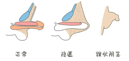 阴茎短小的最新治方法,“阴茎短小治疗新趋势”